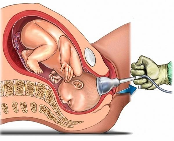2 mặt lợi - hại của sinh mổ so với sinh thường