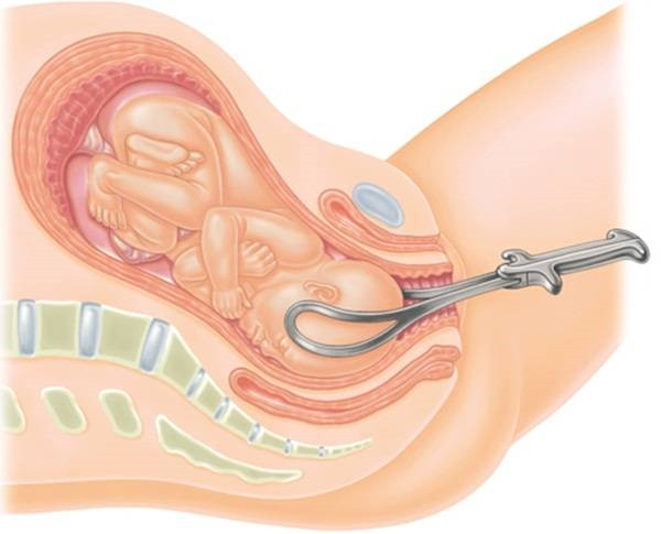 2 mặt lợi - hại của sinh mổ so với sinh thường