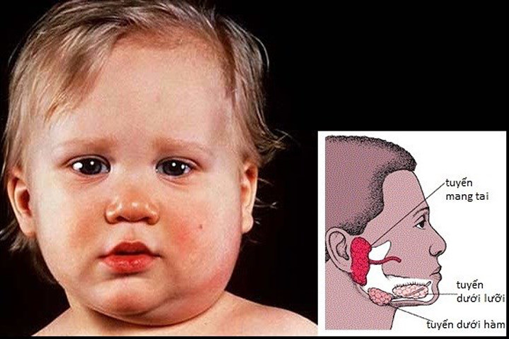 Làm gì khi con trẻ mắc quai bị?