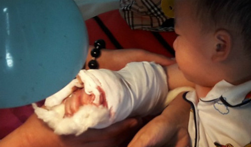 Sơ cứu đúng cách khi gặp tai nạn làm dập nát, đứt lìa chi