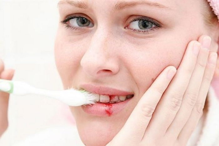 Chảy máu chân răng, mất ít máu nhưng không được xem nhẹ