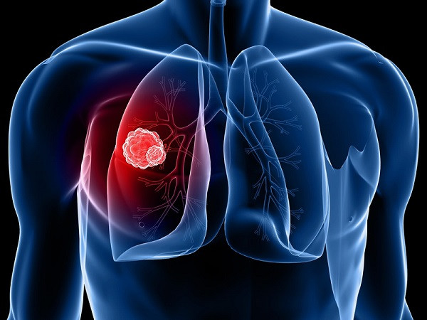 Ung thư phổi có tỷ lệ tử vong cao.