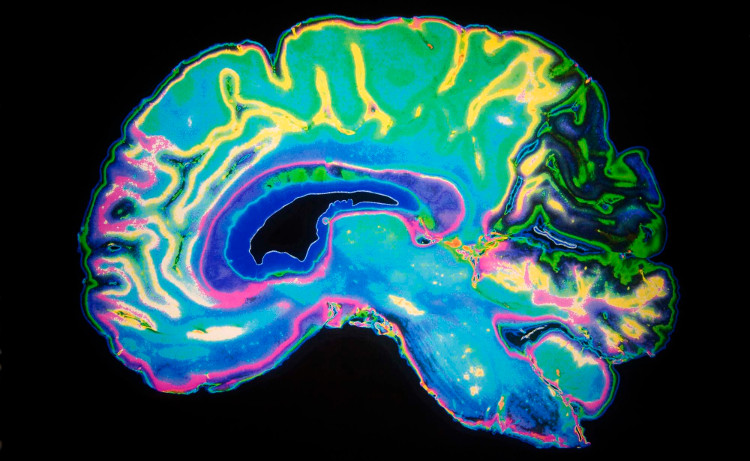 Lạc đường là dấu hiệu đầu tiên của bệnh Alzheimer