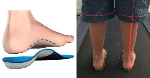 Phương pháp trị liệu không mổ bằng đế giày chỉnh hình y khoa có thể hạn chế đau đớn cho trẻ.