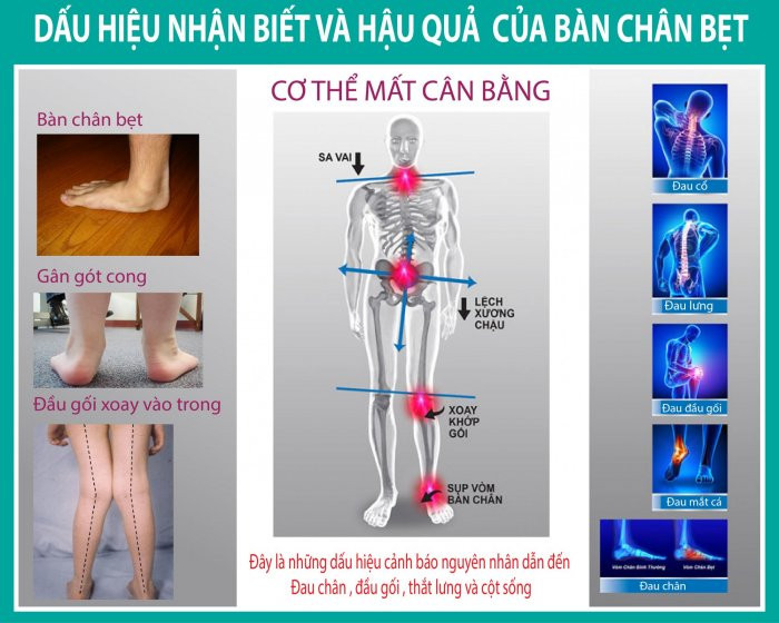 Dấu hiệu của hội chứng bàn chân bẹt