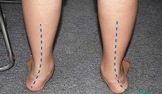 Bàn chân bẹt có xu hướng áp sát vào bên trong hoặc bên ngoài.