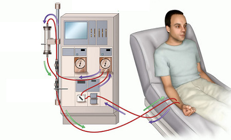 7 lưu ý trong ăn uống khi phải chạy thận người bệnh nên biết