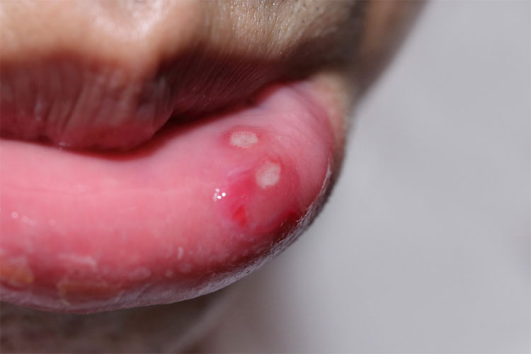 Nhiệt miệng – nguyên nhân, triệu chứng và cách chữa trị