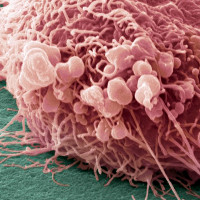 Đã tìm ra nguyên nhân hình thành tế bào ung thư di căn