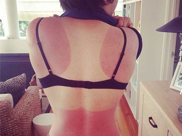 Bác sĩ da liễu gợi ý 3 cách nhanh nhất loại bỏ vết cháy nắng