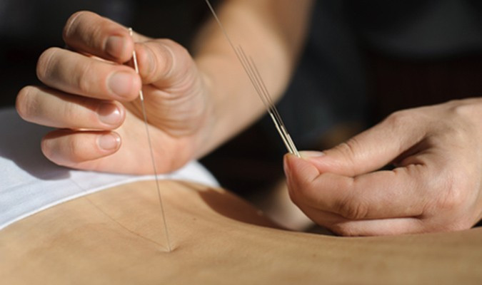 Châm cứu thật sự 