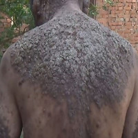 Người đàn ông bị cả làng xua đuổi vì có làn da như thân cây