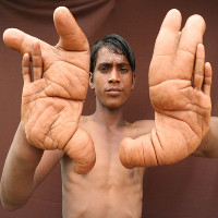 Bàn tay khổng lồ của cậu bé khiến y học bó tay