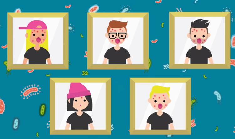 Nguyên nhân gây mụn trứng cá là một loại vi khuẩn có tên gọi Propionibacterium acnes.