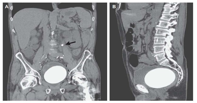 Đau bụng, người đàn ông nhập viện chụp X-quang và thu được một kết quả đáng sợ