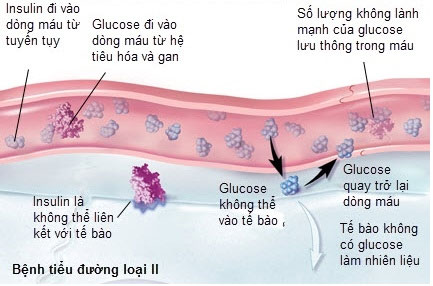 Chế độ ăn mới có thể cứu sống hàng triệu người bị tiểu đường loại 2