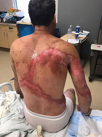 Ba bố con Mỹ sống sót thần kỳ sau khi bị sét đánh