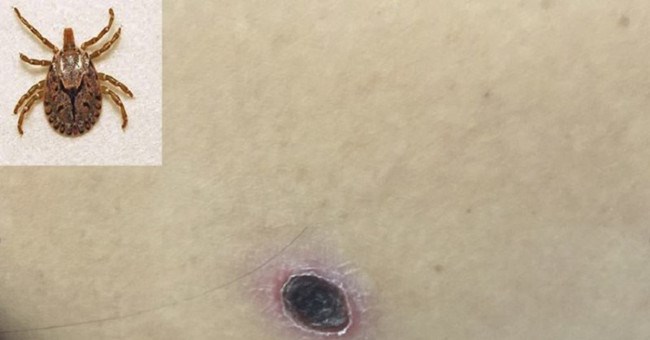 Bệnh sốt mò khó phát hiện, có thể dẫn đến tử vong