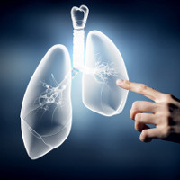 Bước tiến mới trong phẫu thuật ung thư phổi