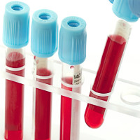 Những điều cần biết về xét nghiệm máu tổng quát