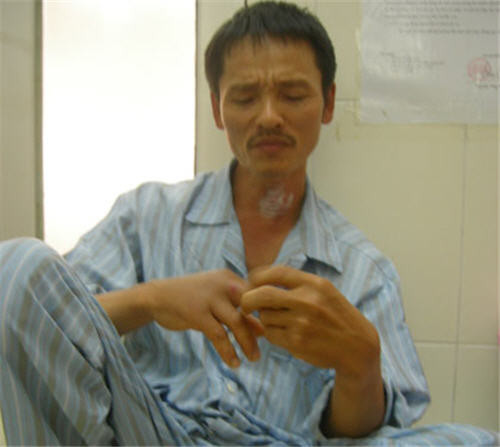 Tổng quan về bệnh sốt chuột cắn - Sodoku