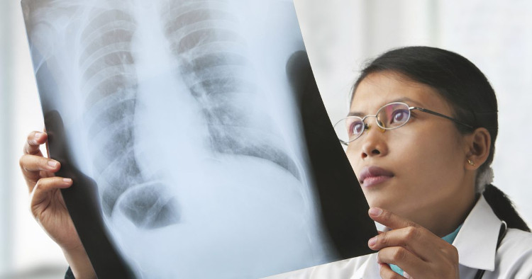 Tầm soát thế nào để phát hiện sớm ung thư phổi?