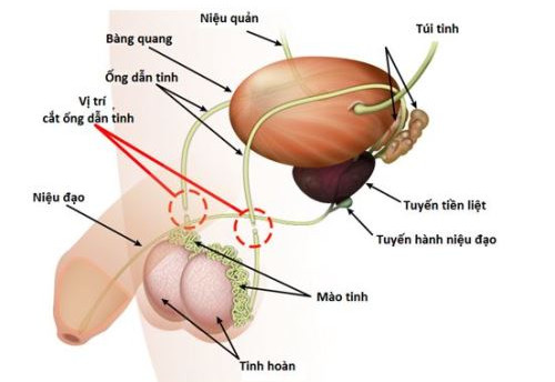 Bác sĩ triệt sản cho đàn ông như thế nào?