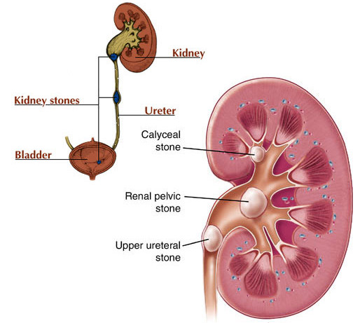 Những điều cần biết về phương pháp tán sỏi thận qua da