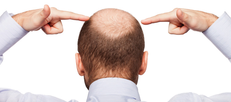 Bệnh hói đầu: Nguyên nhân và triệu chứng