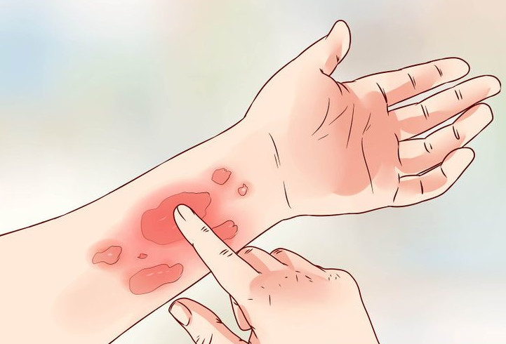 Cứ vào mùa đông lại có hiện tượng ngứa da là do những nguyên nhân này đây