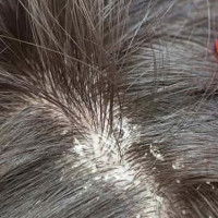 Gàu tróc từng mảng liệu có phải chính là phần da đầu khô bong ra không?