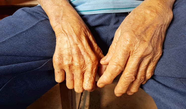 Vi khuẩn cổ đại gây bệnh phong đang đột biến 