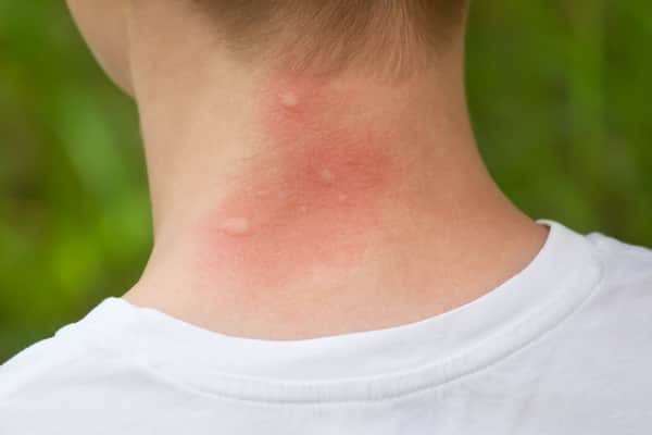 Hóa ra loài muỗi cũng biết sợ khi chúng ta làm điều này