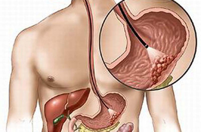 Giải mã đột biến gene để 