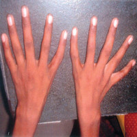 Hội chứng "tay người ngoài hành tinh" khiến ngón cái... biến thành ngón trỏ