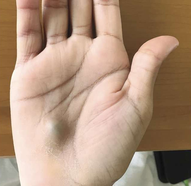 Phát hiện cục bướu lạ ở tay, người đàn ông suýt tử vong vì chứng bệnh nguy hiểm