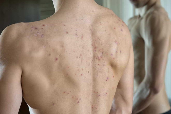 Mọc mụn trứng cá cả ở lưng là biểu hiện cho thấy cơ thể đang bị làm sao?