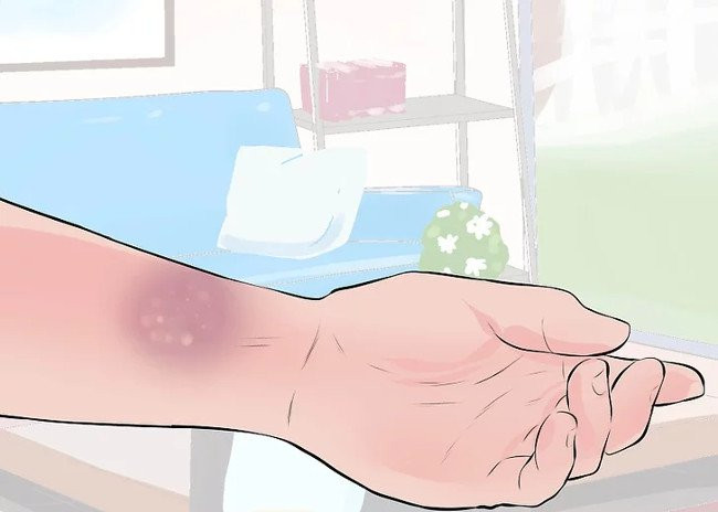 Phân biệt giữa bong gân cổ tay và gãy xương cổ tay