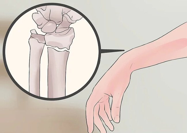 Phân biệt giữa bong gân cổ tay và gãy xương cổ tay
