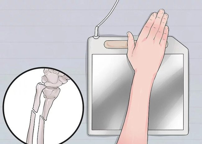Phân biệt giữa bong gân cổ tay và gãy xương cổ tay