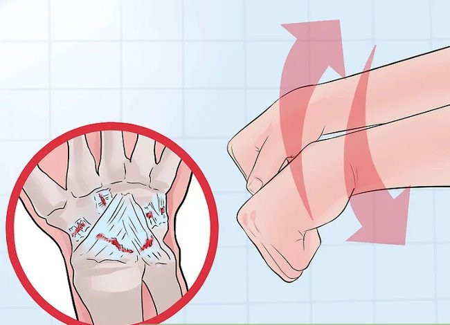 Phân biệt giữa bong gân cổ tay và gãy xương cổ tay