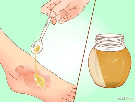 Viên đường giúp vết thương mau lành ngay cả khi thuốc kháng sinh đã “bó tay”?