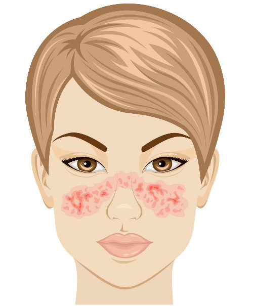 12 dấu hiệu cảnh báo bệnh lupus ban đỏ