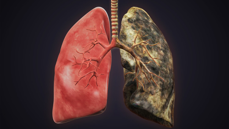 Chỉ dấu sinh học giúp chẩn đoán sớm ung thư phổi