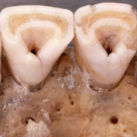 Tại sao chỉ có người Đông Á và thổ dân châu Mỹ có răng sữa hình xẻng?