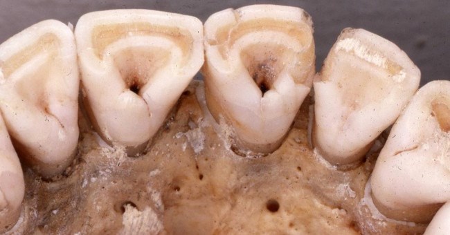 Tại sao chỉ có người Đông Á và thổ dân châu Mỹ có răng sữa hình xẻng?