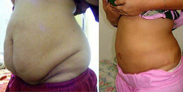 Câu hỏi lớn nhất khi hút mỡ bụng: Hút xong có bị béo lại hay không?