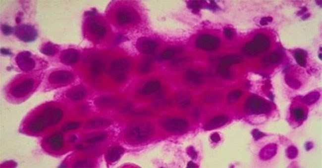 Đi bắt cua, người đàn ông không ngờ mắc phải loại khuẩn gây "rụng" cả tay lẫn chân