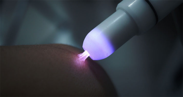 Tia plasma lạnh hỗ trợ làm lành vết thương hở như thế nào?