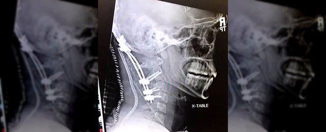 Chàng trai 22 tuổi gây chấn động y học vì sống sót sau tai nạn 